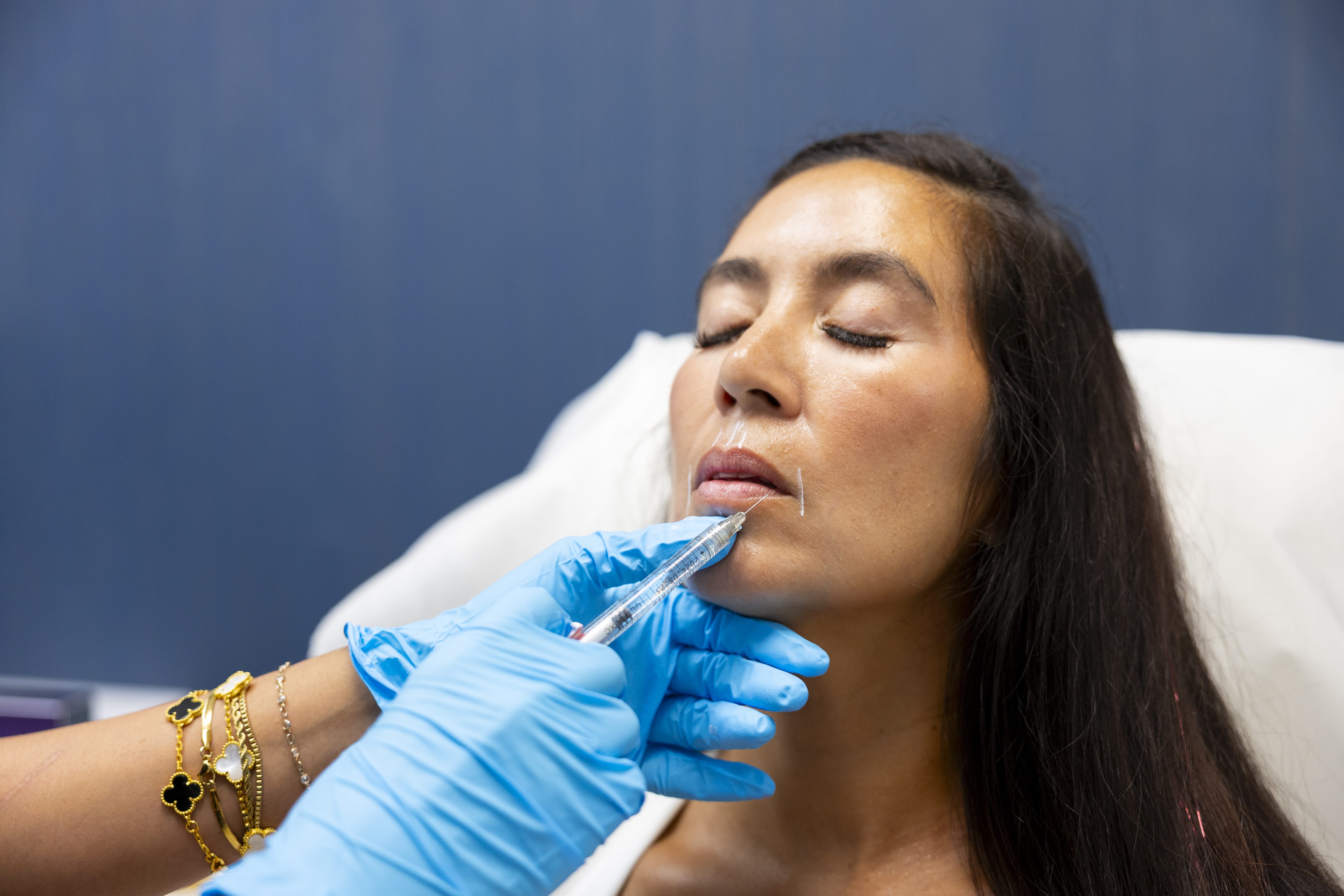 woman receiving dermal filler in Fort Worth, TX