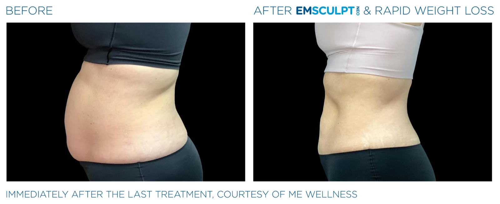 Before and after EMSCULPT NEO with medical weight loss, abdomen side view