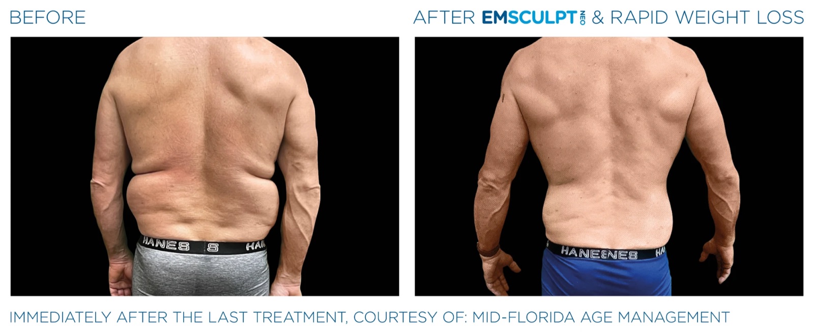 Before and after EMSCULPT NEO with medical weight loss, back view